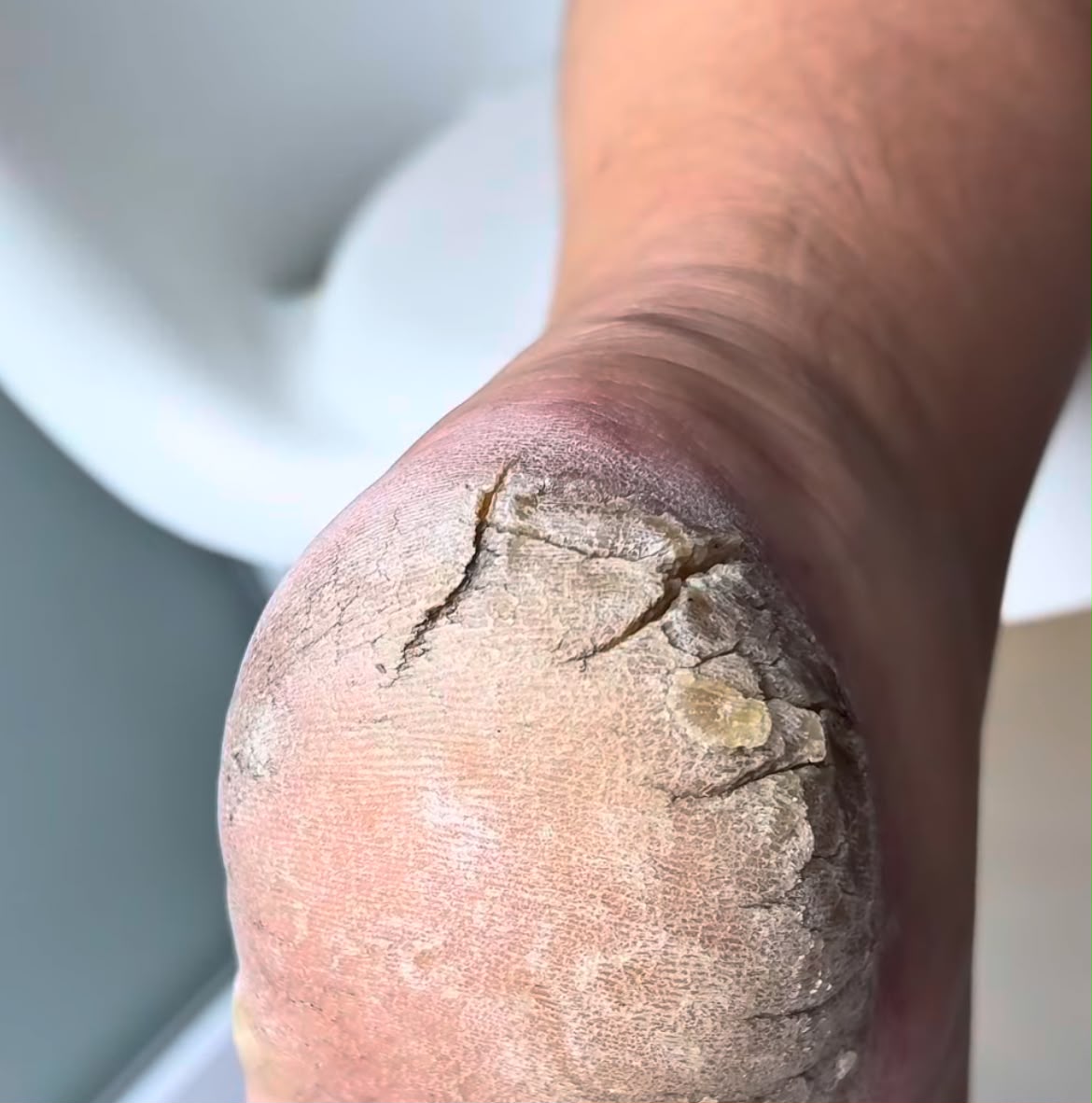 Exemplo de rachaduras nos pés